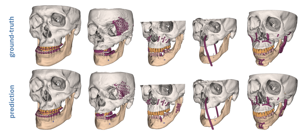 Deep Learning basierte Segmentierung von Unterkiefer, Gesichtsschädel, Zähnen, Kieferkanal und Metallstrukturen als Grundlage für patient*innenspezifisches Implantatdesign.